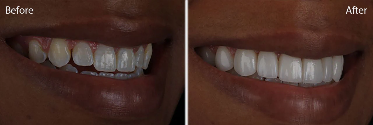 LA Dental Clinic - No Prep Veneers - Before and After 1