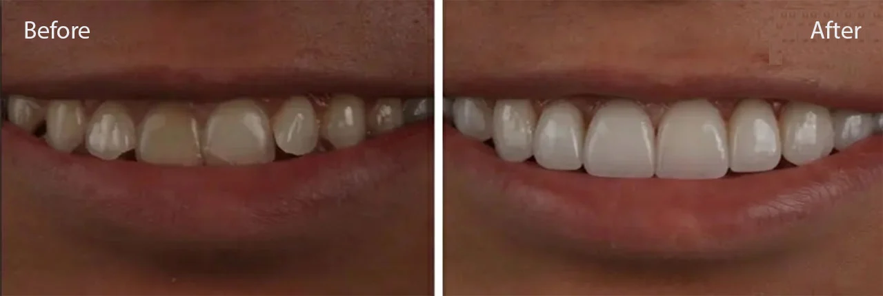No Prep Veneers Before and After photo 3 - LA Dental Clinic