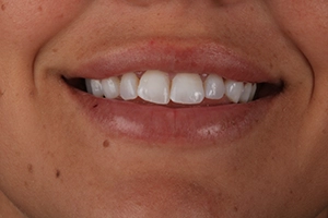 LA-Dental-Clinic-Layerd-Composite-Bonding-1-Before