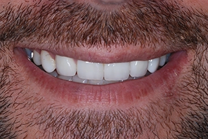 LA-Dental-Clinic-Layerd-Composite-Bonding-10-After