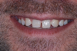 LA-Dental-Clinic-Layerd-Composite-Bonding-10-Before