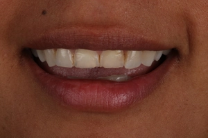 LA Dental Clinic - Layerd Composite Bonding - 2 Before
