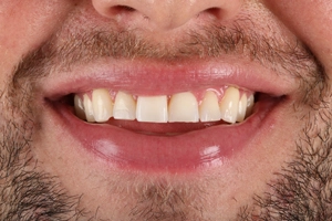 LA Dental Clinic - Layerd Composite Bonding - 3 After