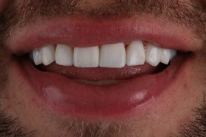 LA Dental Clinic - Layerd Composite Bonding - 3 Before