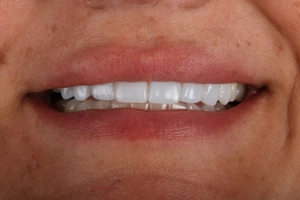 LA Dental Clinic - Layerd Composite Bonding - 4 After