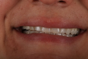 LA Dental Clinic - Layerd Composite Bonding - 4 Before