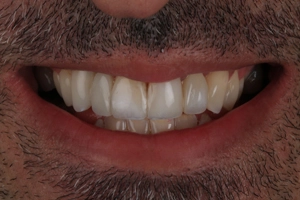 LA Dental Clinic - Layerd Composite Bonding - 5 After