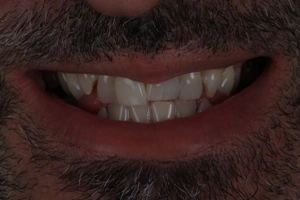 LA Dental Clinic - Layerd Composite Bonding - 5 Before