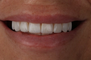 LA Dental Clinic - Layerd Composite Bonding - 6 After