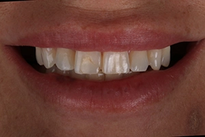LA Dental Clinic - Layerd Composite Bonding - 6 Before