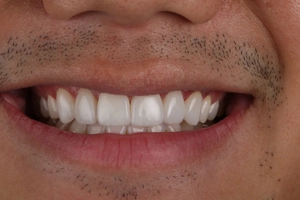 LA Dental Clinic - Layerd Composite Bonding - 7 After
