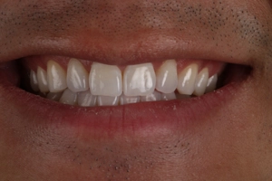 LA Dental Clinic - Layerd Composite Bonding - 7 Before
