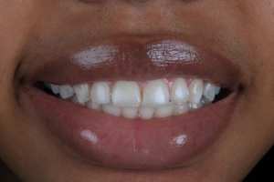 LA Dental Clinic - Layerd Composite Bonding - 8 Before
