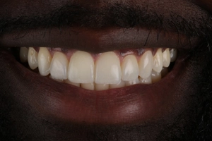 LA Dental Clinic - Layerd Composite Bonding - 9 After