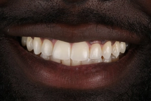 LA Dental Clinic - Layerd Composite Bonding - 9 Before